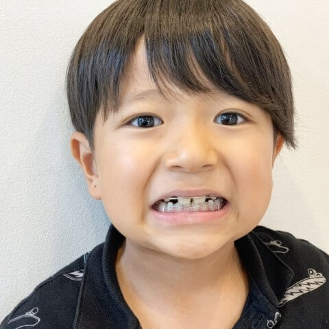 【小児歯科専門医が解説】わが子の「歯並び」が気になっている人必見!早めに進めたい治療のタイミングや矯正方法って?